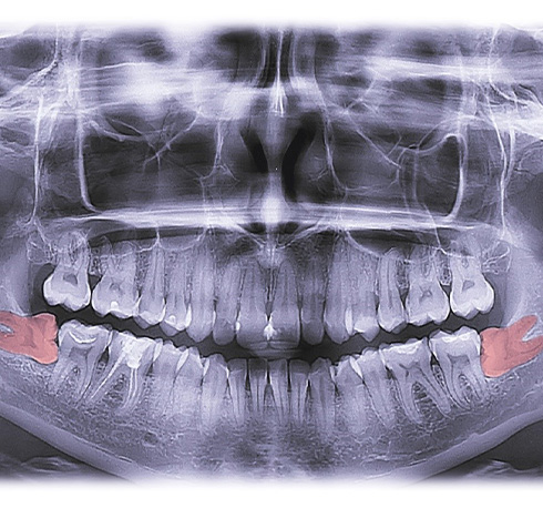 Young man with healthy smile after wisdom tooth extraction